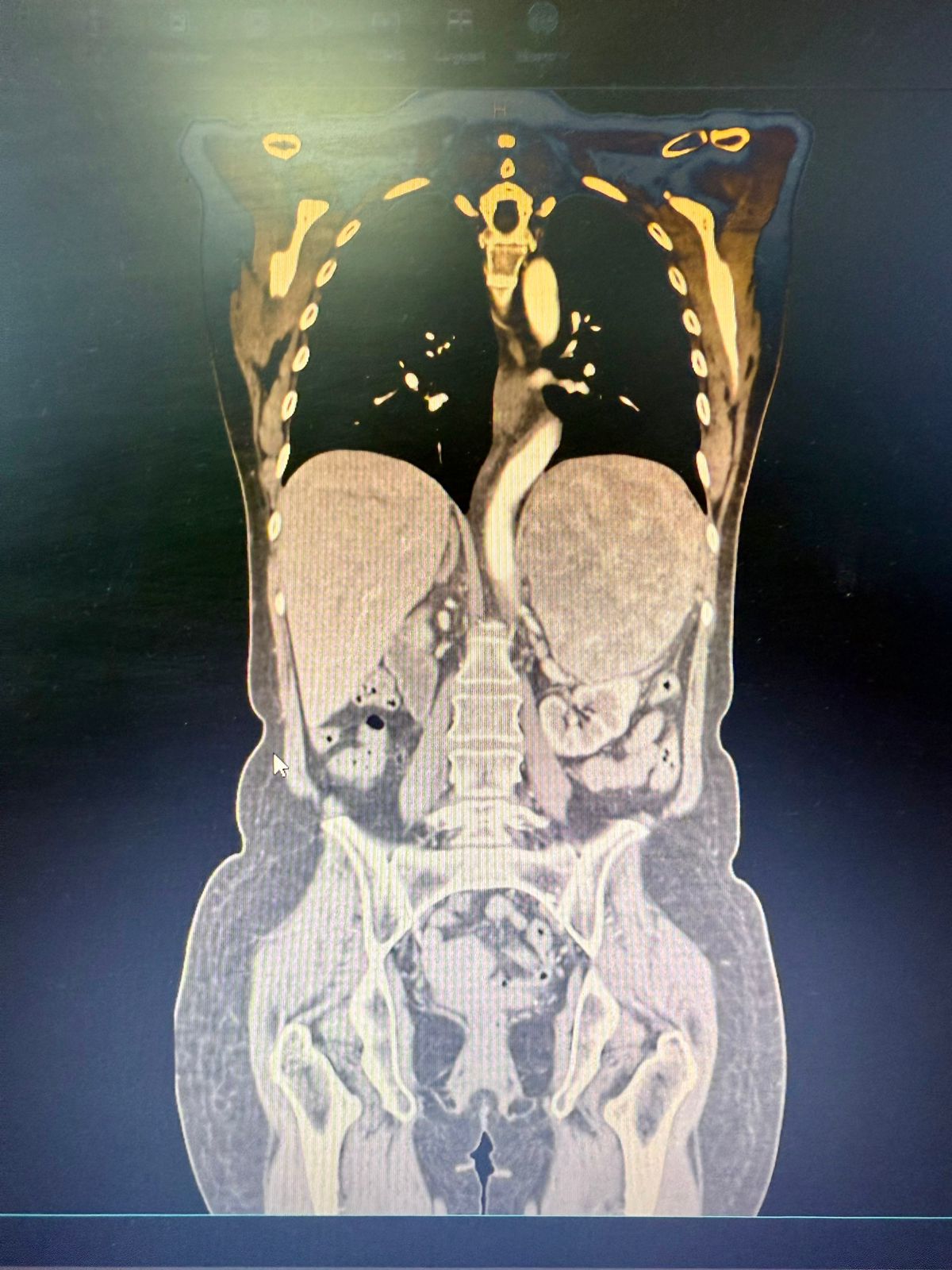 Inédita cirugía de extirpación de tumor en el IPS INGAVI