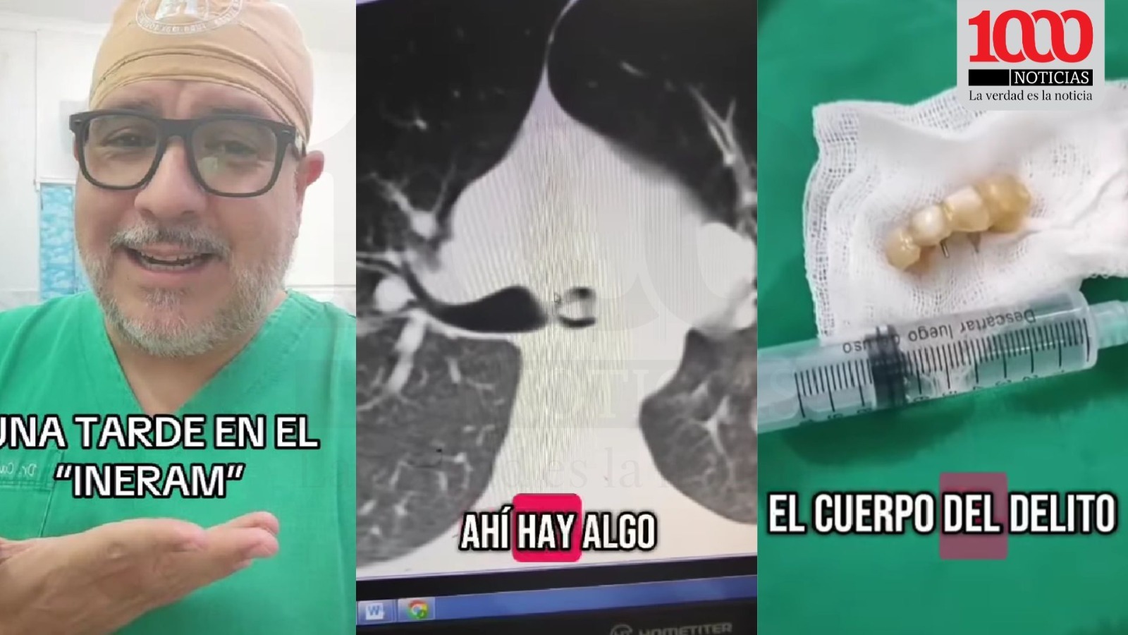 Extraen dientes postizos del pulmón de un hombre
