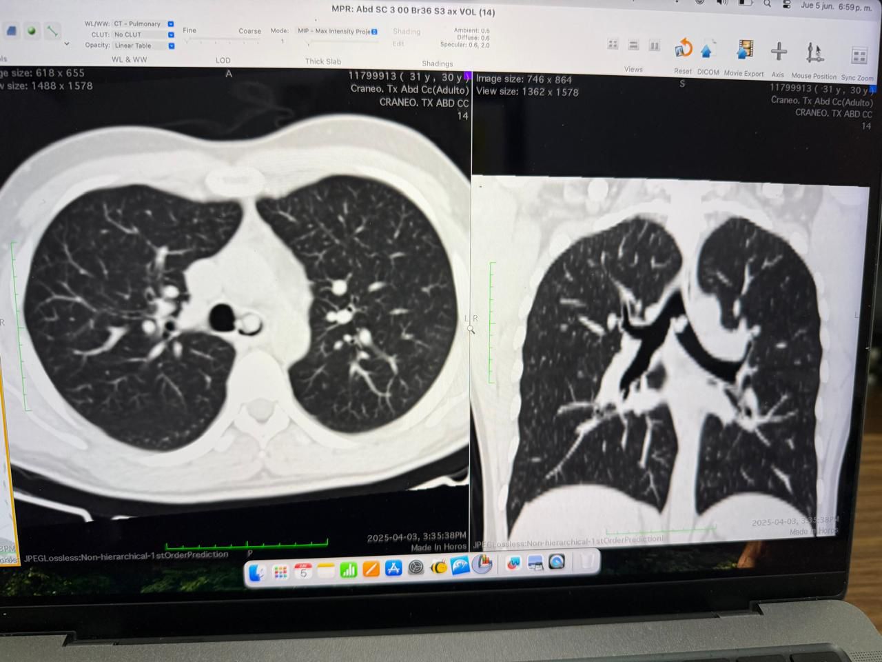 IPS INGAVI lleva a cabo una pionera extracción de un tumor