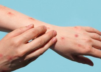 Unos 35 casos positivos de sarampión en San Pedro