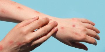 Unos 35 casos positivos de sarampión en San Pedro