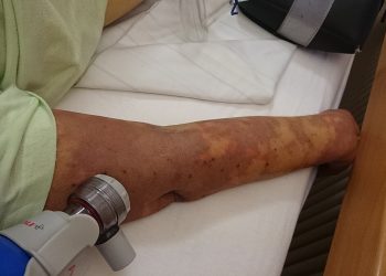 El pasado sábado se recordó el Día Mundial de la Sepsis