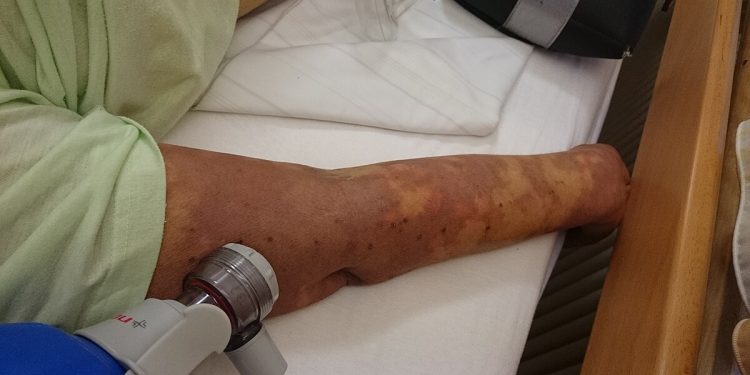 El pasado sábado se recordó el Día Mundial de la Sepsis