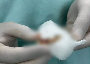 Médicos lograron extraer cinco dientes que se alojaron en el bronquio de un paciente