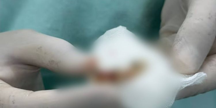 Médicos lograron extraer cinco dientes que se alojaron en el bronquio de un paciente