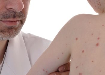 Sarampión en San Pedro: confirman 35 casos y evalúan otros 14 como sospechosos