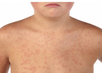 Confirman un caso de sarampión en Central y elevan a 44 los afectados