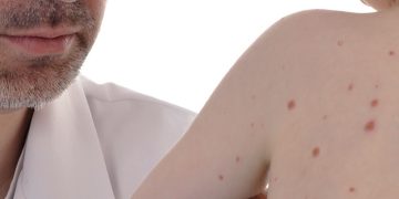 Sarampión en San Pedro: confirman 35 casos y evalúan otros 14 como sospechosos