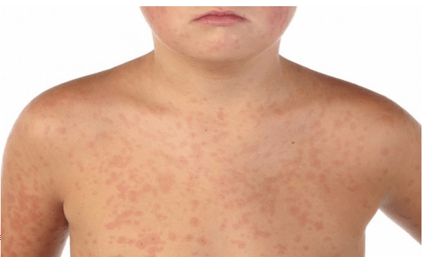 Confirman un caso de sarampión en Central y elevan a 44 los afectados