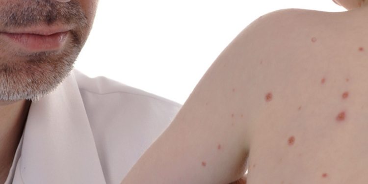 Sarampión en San Pedro: confirman 35 casos y evalúan otros 14 como sospechosos