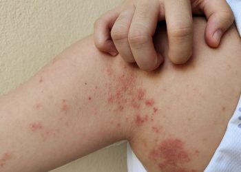 Lepra: notificaciones de casos se mantienen dentro de los rangos normales