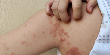 Lepra: notificaciones de casos se mantienen dentro de los rasgos normales