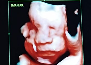 Nacimiento de trillizos prematuros en el Hospital Central del IPS