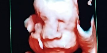 Nacimiento de trillizos prematuros en el Hospital Central del IPS