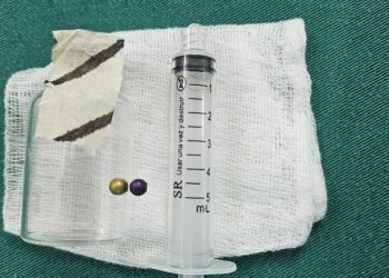 Niña se recupera tras extraerle perla metálica del pulmón