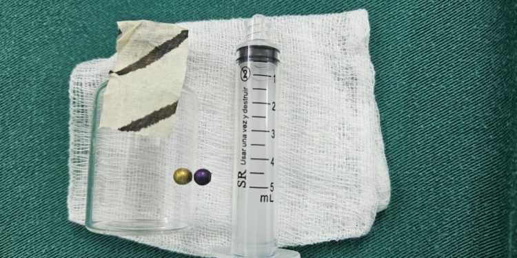 Niña se recupera tras extraerle perla metálica del pulmón