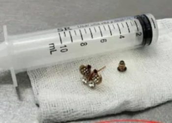 Una bebé de 10 meses tragó un arito y fue intervenida en el Ineram