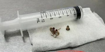 Una bebé de 10 meses tragó un arito y fue intervenida en el Ineram