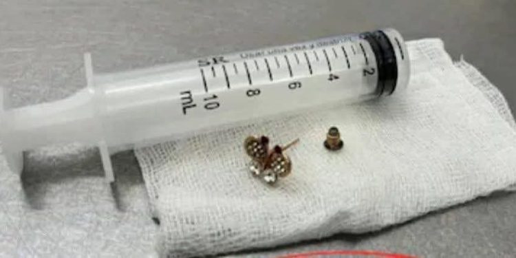 Una bebé de 10 meses tragó un arito y fue intervenida en el Ineram