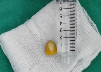 Niño de 4 años se asfixió con granos de maíz y fue salvado a tiempo en el INERAM