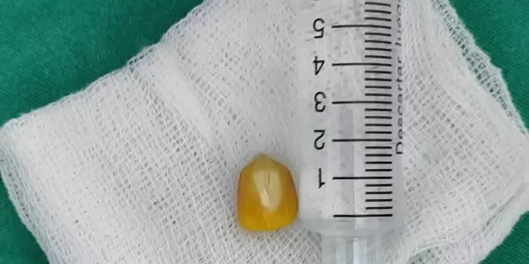 Niño de 4 años se asfixió con granos de maíz y fue salvado a tiempo en el INERAM