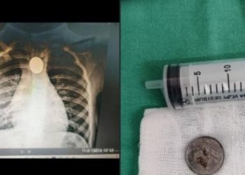 Extraen moneda atascada del esófago de una niña de 3 años