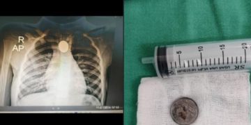 Extraen moneda atascada del esófago de una niña de 3 años