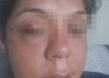 Mujer que sufrió agresión por parte de su ex pareja reclama justicia