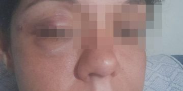 Mujer que sufrió agresión por parte de su ex pareja reclama justicia