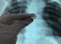 Hallan anillo de oro en forma de mariposa en el pulmón de un paciente en el Ineram