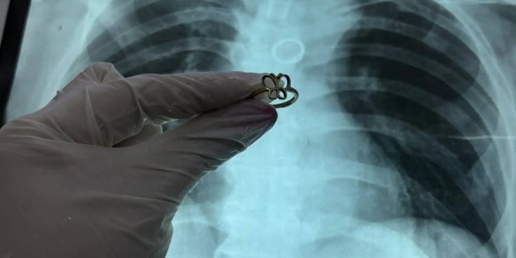Hallan anillo de oro en forma de mariposa en el pulmón de un paciente en el Ineram