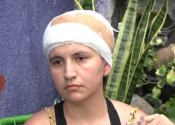 Mujer que perdió el cuero cabelludo en accidente pide ayuda para continuar su tratamiento