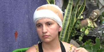Mujer que perdió el cuero cabelludo en accidente pide ayuda para continuar su tratamiento