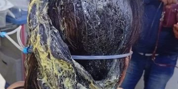 Por celos, hombre derramó pegamento para zapatos en el cabello a su pareja