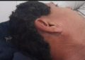 Hombre sobrevivió tras ser alcanzado por la descarga de un rayo