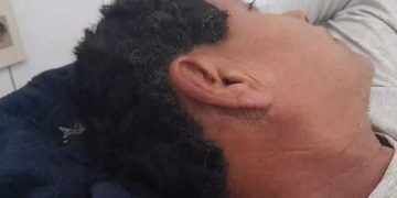 Hombre sobrevivió tras ser alcanzado por la descarga de un rayo