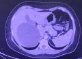Realizan cirugía laparoscópica para tratar un quiste hepático gigante en IPS Ingavi