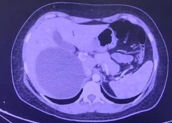 Realizan cirugía laparoscópica para tratar un quiste hepático gigante en IPS Ingavi