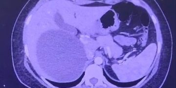 Realizan cirugía laparoscópica para tratar un quiste hepático gigante en IPS Ingavi