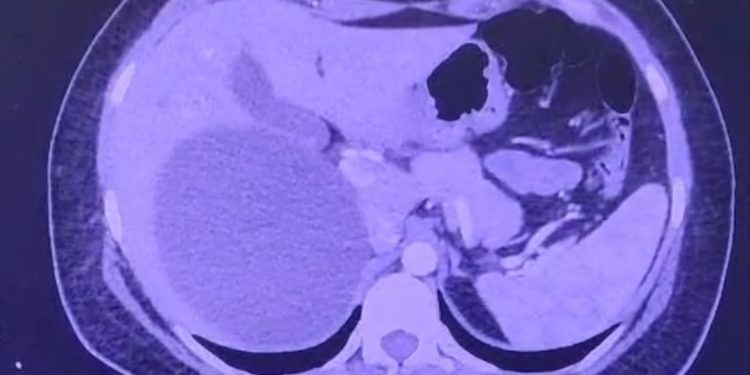 Realizan cirugía laparoscópica para tratar un quiste hepático gigante en IPS Ingavi