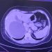 Realizan cirugía laparoscópica para tratar un quiste hepático gigante en IPS Ingavi