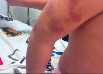 Padrastro fue aprehendido por agredir salvajemente a niña autista en Pedro Juan Caballero
