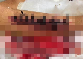 Familiares denuncian supuesta negligencia tras cierre de una herida con cintillos plásticos a adulto mayor