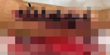 Familiares denuncian supuesta negligencia tras cierre de una herida con cintillos plásticos a adulto mayor