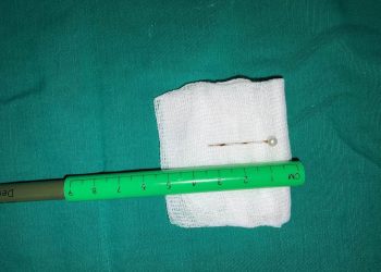 Médicos del INERAM salvan a una niña tras extraerle un alfiler del pulmón