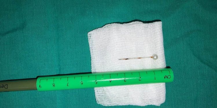 Médicos del INERAM salvan a una niña tras extraerle un alfiler del pulmón