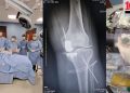 IPS Ingavi realiza por primera vez una prótesis parcial de rodilla