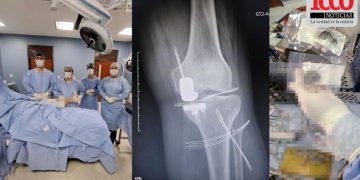 IPS Ingavi realiza por primera vez una prótesis parcial de rodilla
