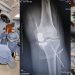 IPS Ingavi realiza por primera vez una prótesis parcial de rodilla