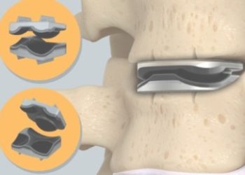 IPS marca un hito mundial al implantar tres discos cervicales artificiales en una misma cirugía